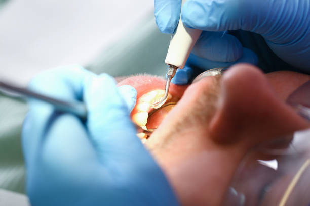 Best Emergency Dental Care for Broken or Chipped Teeth in Odenton, MD